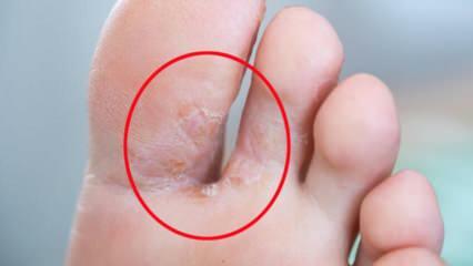 Ce este ciuperca piciorului? Care sunt simptomele ciupercii piciorului? Există un leac pentru piciorul unui atlet?