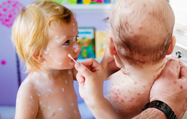 Simptomele varicelei la începutul copilăriei și copilăriei