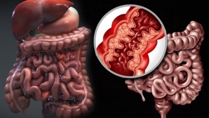 Care este boala Crohn? Care sunt simptomele bolii Crohn? Există un remediu pentru Crohn?