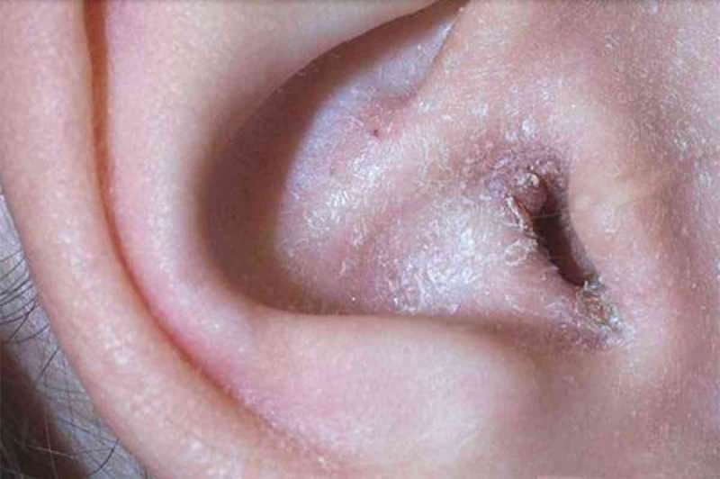 Ce cauzează peelingul în spatele urechii și cum trece? Soluția definitivă pentru eczema din spatele urechii ...