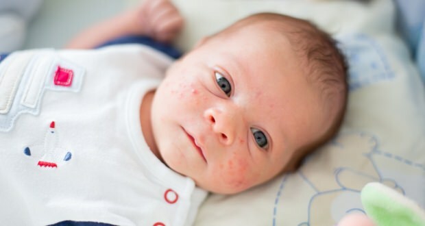 Cum trece acneea pe fața copilului? Metode de uscare a acneei (Milia)