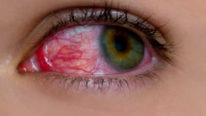Ce provoacă alergie la ochi? Care sunt simptomele alergiei oculare? Ce este bun pentru alergiile oculare? 