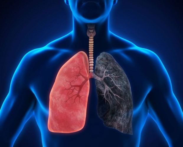 ce este cancerul pulmonar