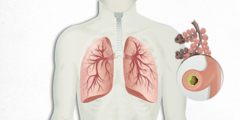 virusul care se instalează în plămâni este amestecat cu pneumonie