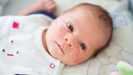 Cum trece acneea pe fața copilului? Metode de uscare a acneei (Milia)