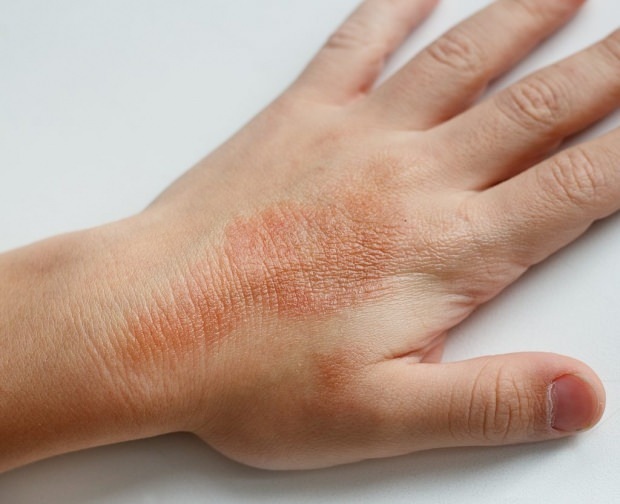 eczema în mână