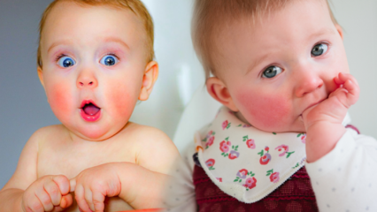 Atenție la bebelușii cu obraji roșii! Sindromul obrazului și a simptomelor sale