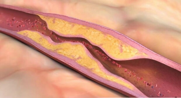 Ce cauzează ateroscleroza? Câte tipuri de ocluzie vasculară există?