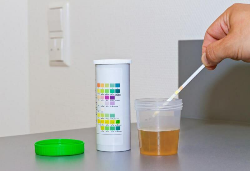 nivelul de bilirubină apare de obicei în testul urinei