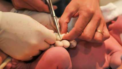 Când este tăiat cordonul ombilical la bebeluși? Avantajele tăierii cordonului ombilical târziu