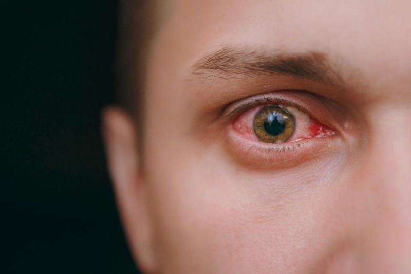 udarea ochilor, sângerare și mâncărimi ale simptomelor coronavirusului