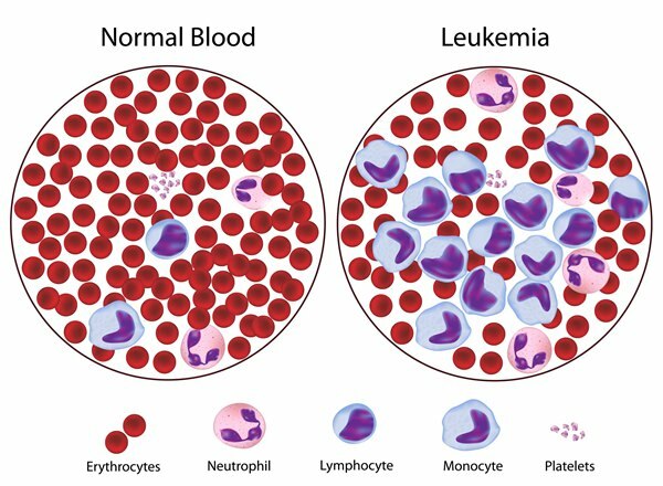 ce este leucemia