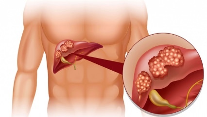 Care sunt simptomele cancerului hepatic? Există un tratament al cancerului hepatic?