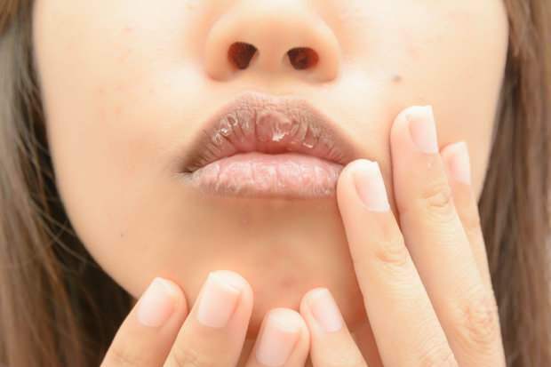 anemia provoacă buzele uscate