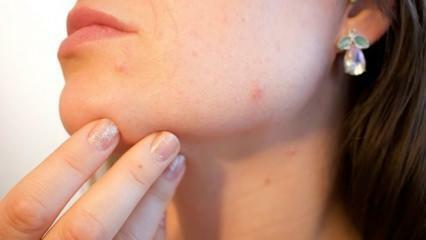 Ce este cancerul de piele (melanomul)? Care sunt simptomele melanomului și există un remediu?