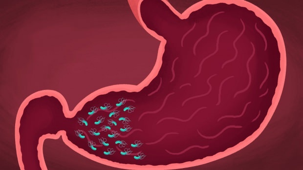 unele virusuri și bacterii pot provoca gastrită