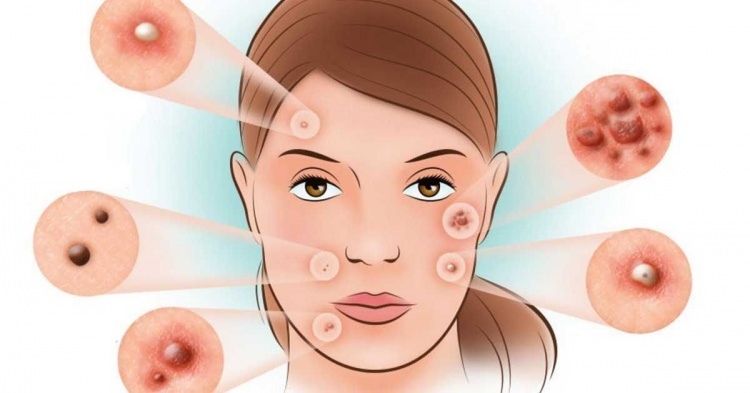 Cum sunt tratate acneea?