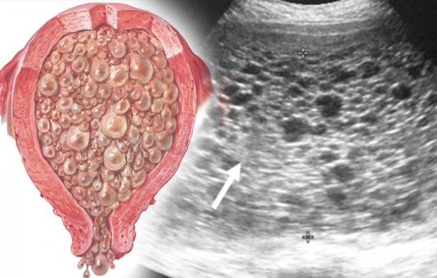 Care sunt simptomele sarcinii de struguri ale sarcinii de struguri