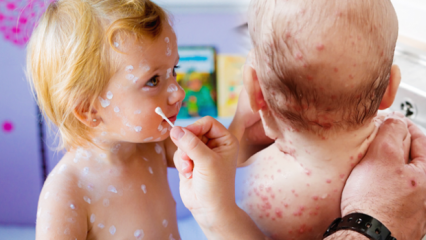Cum să înțelegem varicela în copilărie și în copilărie? Simptome și tratament ale varicelei