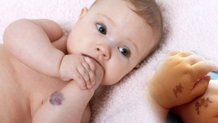 Cauză semne de naștere la bebeluși, este permanent? Care sunt tipurile de repere de naștere? Vindecă de la Saracoglu