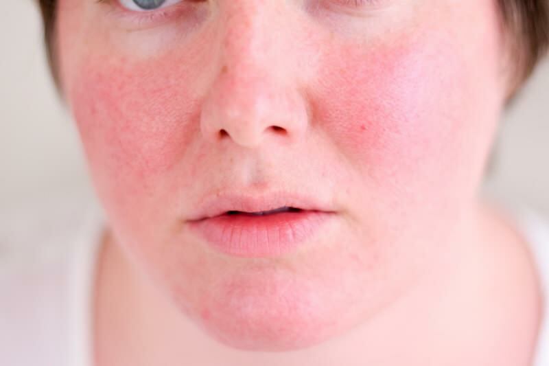 Cum trece fața înroșită? Cele mai bune produse de îngrijire împotriva roșeaței faciale