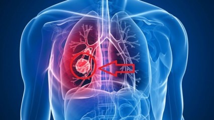 Simptomele cancerului pulmonar: stadiile cancerului pulmonar!