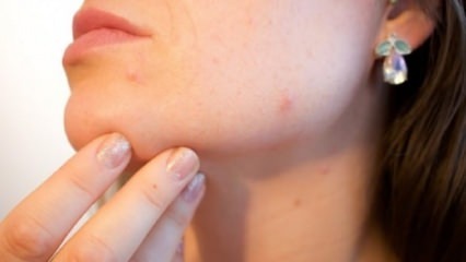 Remediu natural pentru acnee pe bărbie