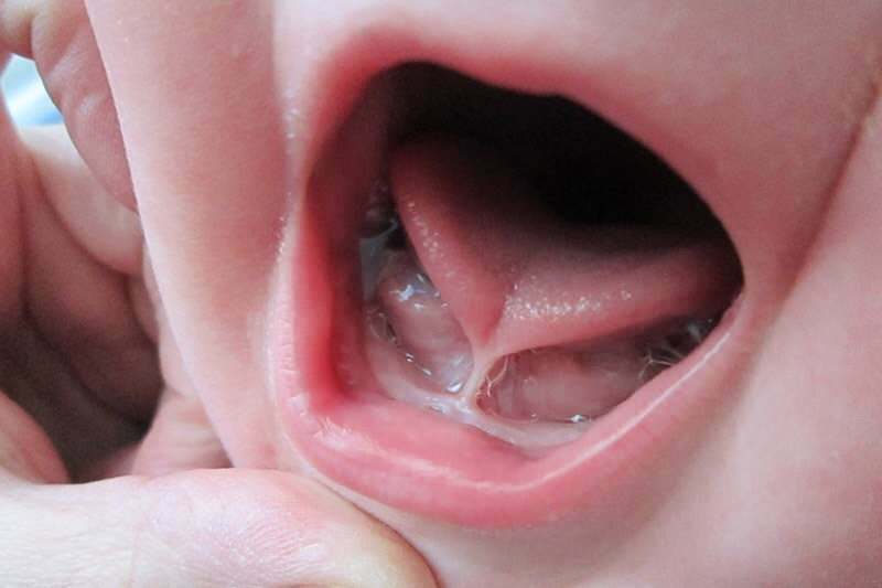 Simptomele și tratamentul legăturii limbii la sugari