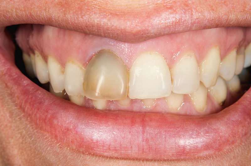 întunecarea dinților se poate concentra uneori pe un dinte