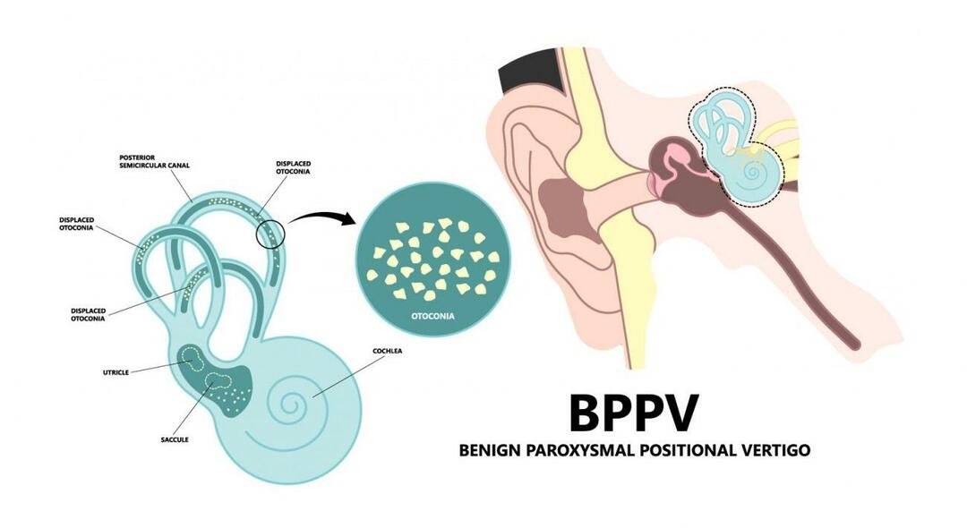 De ce se învârte capul când stai întins? Ce este bun pentru vertijul pozițional paroxistic benign? Cum să scapi de BPPV