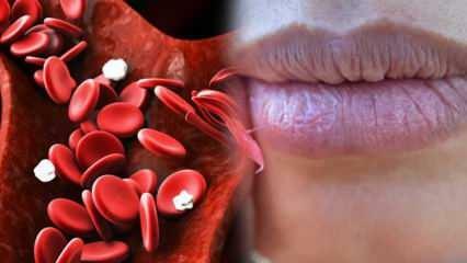 Ce este Anemia? Slăbiciunea constantă este un semn de anemie! Alimente care sunt bune pentru anemie ...