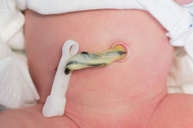 Când cad cordonul ombilical la bebeluși?