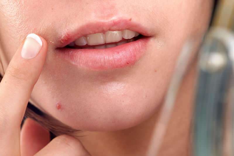 herpesul iese de obicei pe marginea buzelor.
