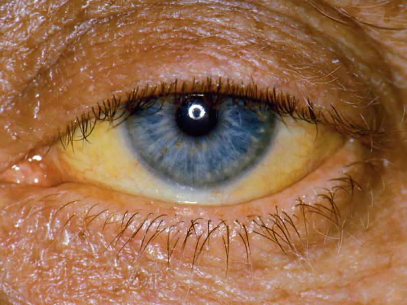 înălțimea la nivelul bilirubinei provoacă culoare galbenă asupra ochilor și pielii