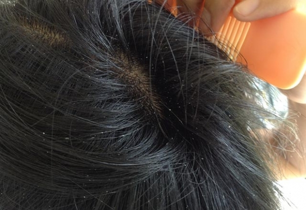 De ce acnee pe scalp
