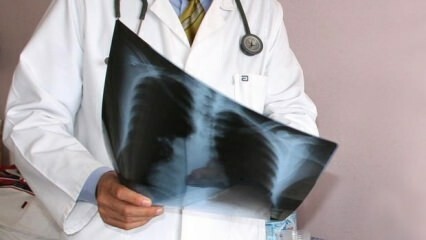 Experți anunțați! Creșterea deceselor prin cancer pulmonar