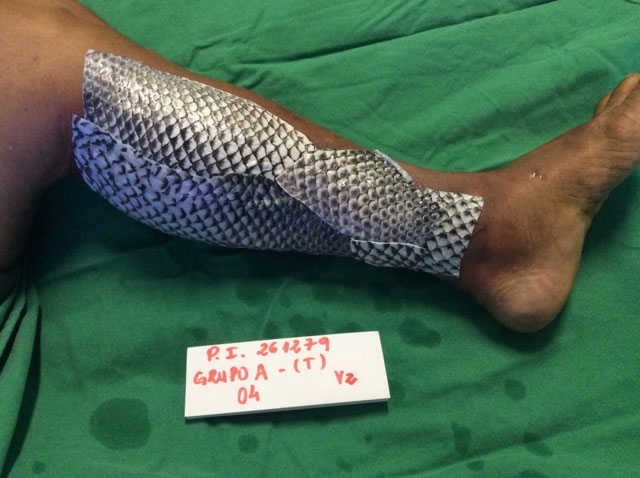 Pielea de pește a trecut în istoricul medical în tratamentul arsurilor