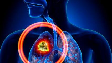 Care sunt simptomele cancerului pulmonar? Există un tratament pentru cancerul pulmonar?