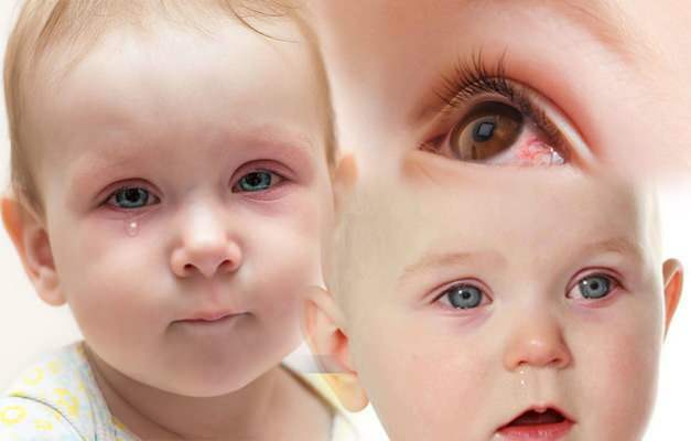 De ce ochii copiilor primesc sânge? Cum trece sângerarea ochilor la un nou-născut?