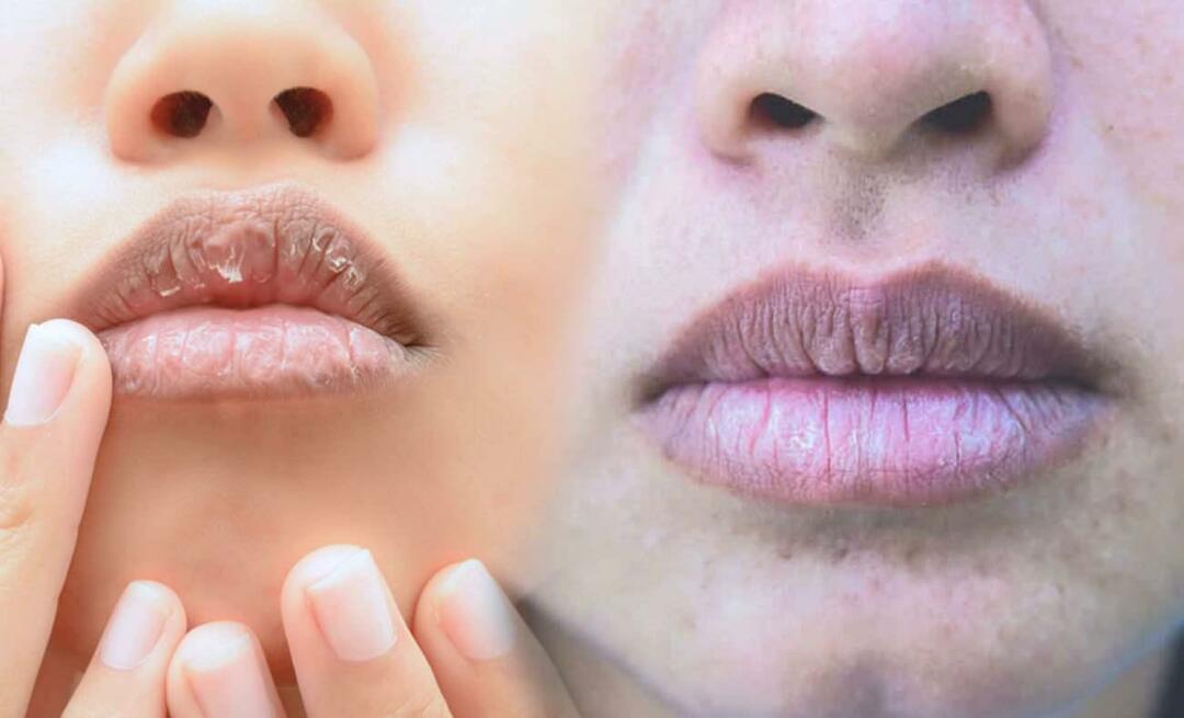 Ce cauzează buzele întunecate? Cum se tratează întunecarea buzelor sau vânătăile?