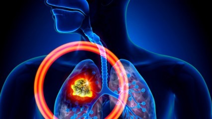 Care sunt simptomele cancerului pulmonar? Există un tratament pentru cancerul pulmonar? Pentru a preveni cancerul pulmonar ...