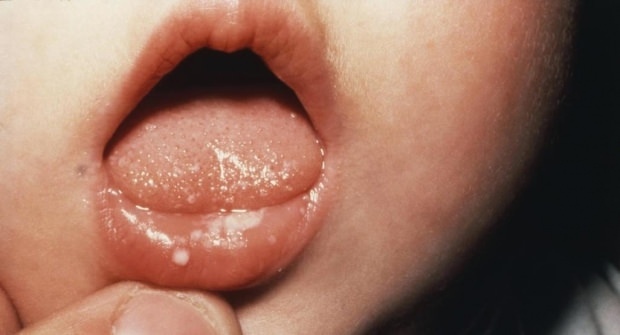 Cum sunt răni la gură la copii