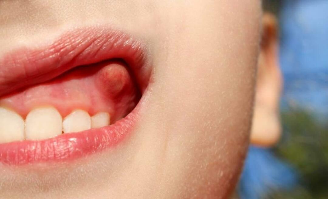 De ce apare abcesul dentar și care sunt simptomele? Abcesul dentar, cum se trateaza?
