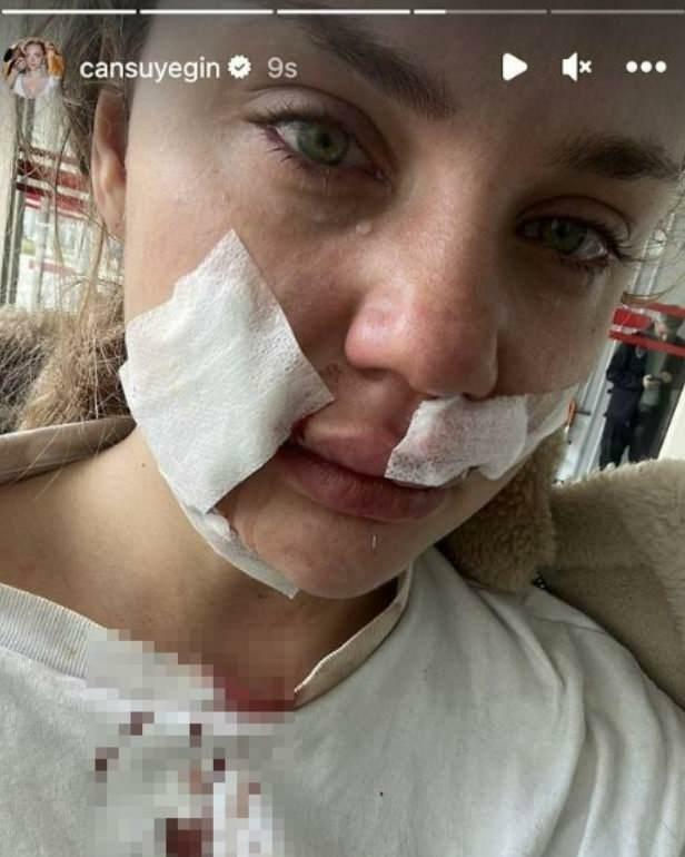 Cansu Yeğin a fost atacat de un câine