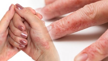 Ce este eczema? Cum este eczema cea mai ușoară? Colonia cauzează eczeme mâini? 