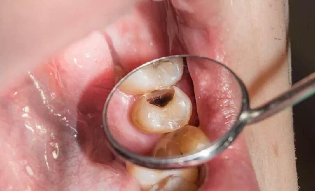 De ce putrezesc dinții și ce putem face pentru a o preveni? 