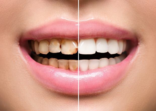 Ca urmare a alimentației nesănătoase, se produce atât decolorarea dinților, cât și pierderea dinților
