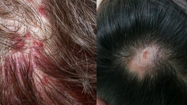 De ce apare acneea pe scalp