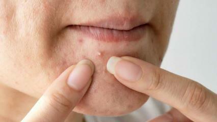 De ce apare acneea pe bărbie? Soluție naturală pentru acnee pe bărbie