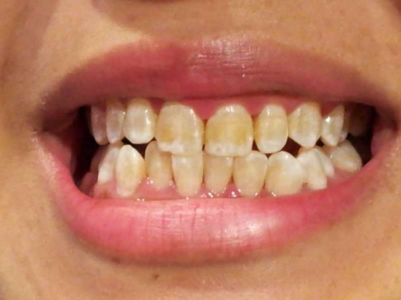 imaginea dinților a unei persoane ai cărei dinți încep să se întunece